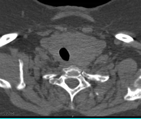 Thyroid Goiter Displaces The Trachea In 3d Chest Case Studies