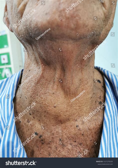 Anterior Neck Swelling Goitre Enlargement Thyroid Stock Photo