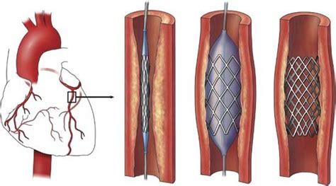 Stenting — Dr Christopher Quirk Cardiologist