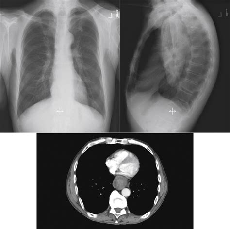 The Lateral Chest Radiograph Radiology Key