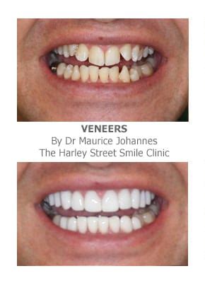 A large number of my patients undergo orthodontic treatment prior to placement of the porcelain or dental veneers. Veneers for Crooked Teeth | Harley Street Smile Clinic