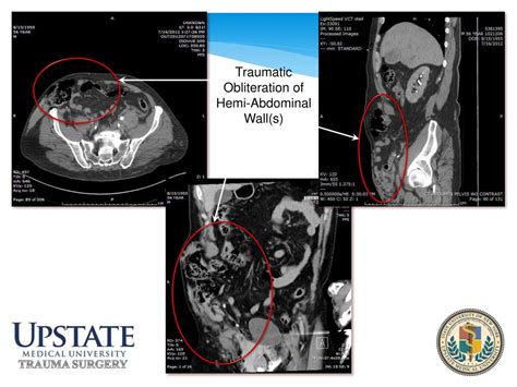 Ppt Abdominal Wall Domain Reconstruction After Trauma Powerpoint