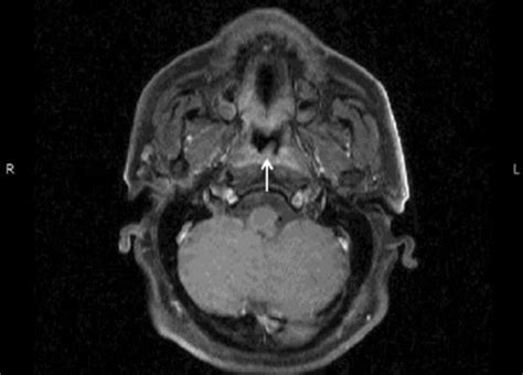 Magnetic Resonance Imaging In Axial Plane Showing A Nasopharyngeal Mass