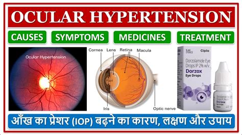 Ocular Hypertension आँख का प्रेशर बढ़ने का कारण लक्षण और उपाय Eye