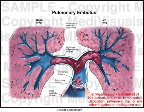 Medivisuals Pulmonary Embolus Medical Illustration