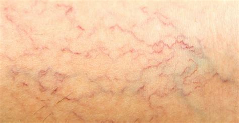 Common Causes Of Spider Veins Fort Myers Fl Cardiology Consultants