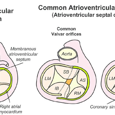 Diagram Showing The Normal Atrioventricular Junction Left And The