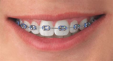 ® odontologoscol en noticias odontológicas brackets dentales