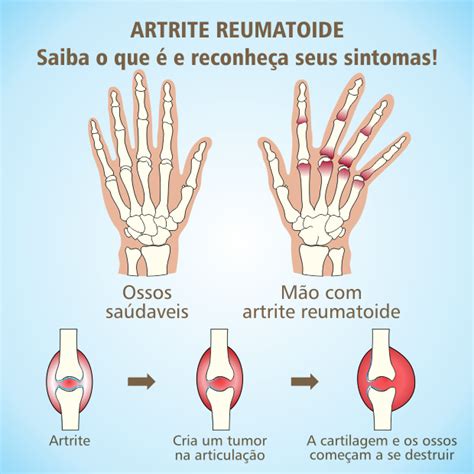 Artrite Blog — Os Sintomas Mais Comuns De Artrite Reumatoide