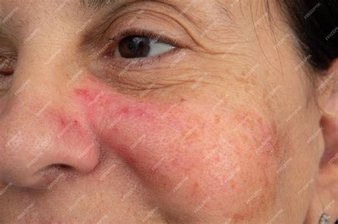 Premium Photo A Case Of Early Rosacea On A Woman39s Face