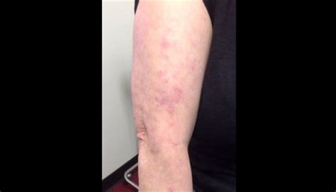 Clinical Challenge Recurring Rash After Sun Exposure Mpr