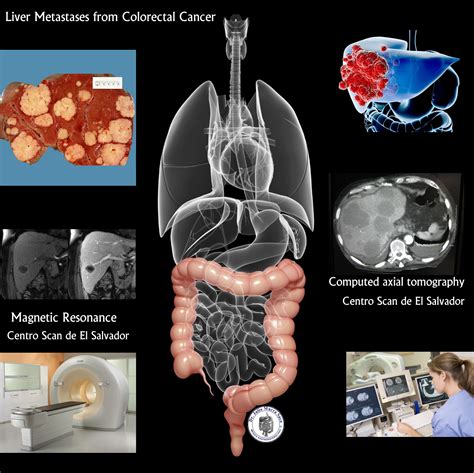 How The Cancer Comes Notas Sobre Gastroenterología Cibernética
