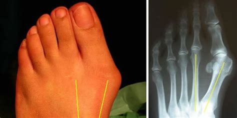 Bunions Causes Symptoms And Treatment Brandon Orthopedics