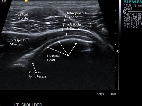 13 Point Shoulder Ultrasound Ultrasound Radiology Imaging Study Hard