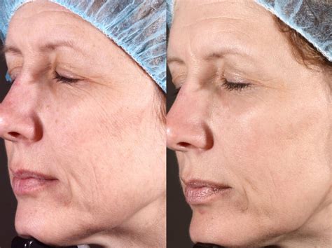 Laser Facial Before And After Emerge Fractional Laser Results