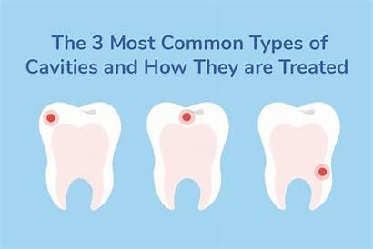Types Cavities Dental Cavity Treatment Root Treat