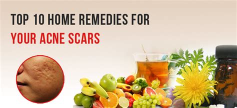 top 10 home remedies for acne scars how to remove acne from face naturally sehat