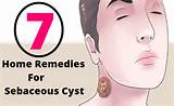 Home Remedies Sebaceous Cyst Photos