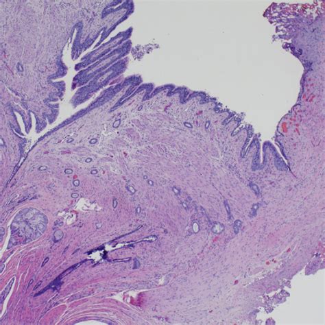 He Section Shows A Large Cyst Lined By Respiratory Epithelium There