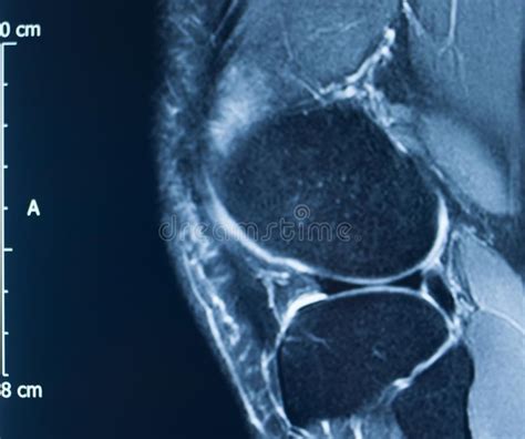 Knee Injury Mri Mcl Tear Stock Image Image Of Injury 154117367