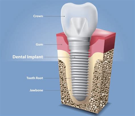 Everything You Need To Know About Bone Grafting For Dental Implants