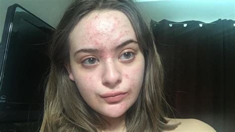 Unexpected emphasizes the lack of preparedness for what occurs or appears: Very sudden massive breakout all over face - General acne ...