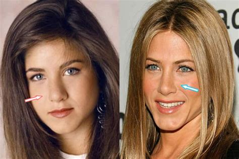 Has Jennifer Aniston Had Plastic Surgery? (Before & After 2018)