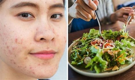 Acne Diet The 3 Foods To Avoid For Clear Skin Safe Home Diy