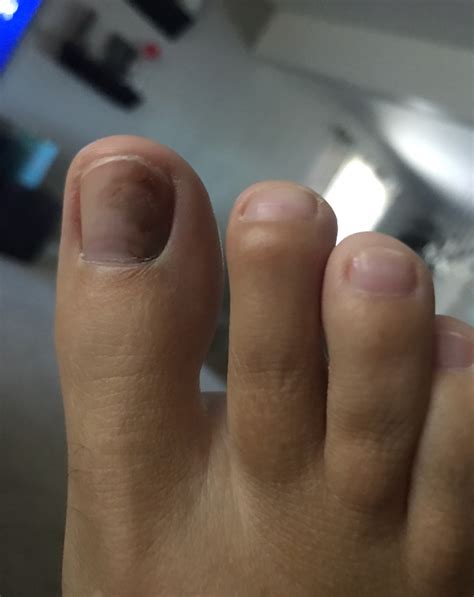 I Noticed My Big Toe Nail Was All Bruised Looking 6 Weeks Ago And It