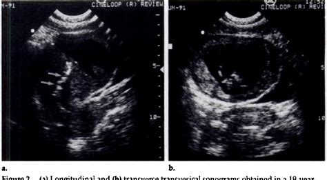 Figure 2 From Interstitial Line Sonographic Finding In Interstitial