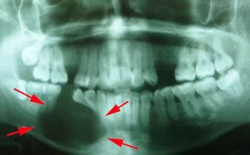 Tumores Odontogênicos A Importância do Diagnóstico Precoce ABC da Saúde