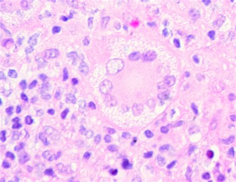 Touton Giant Cell In A Juvenile Xanthogranuloma From The N Flickr
