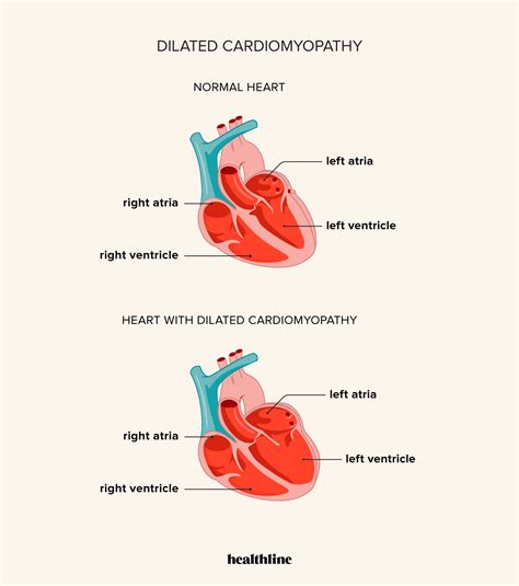 Dilated Cardiomyopathy Dcm Symptoms Causes Treatment Outlook