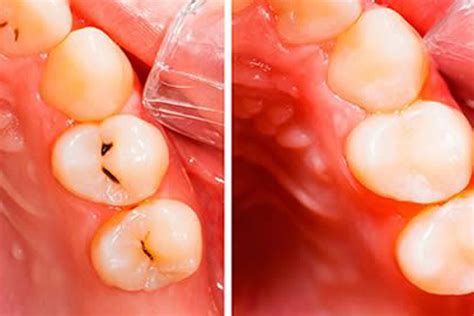 How to know if u have a cavity. How to Keep Cavity from Getting Worse? | Eve Dental Centre ...