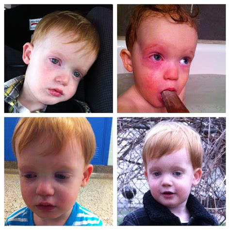 Food Allergy Reactions Food Allergies A Toddler