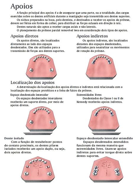 Protese Ppr Com Grampo