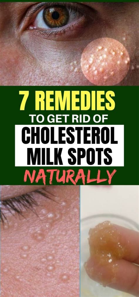 7 Remedies To Get Rid Of Cholesterol Milk Spots Naturally Wellness