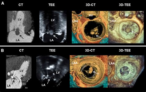 Comparison Of Cardiac Computed Tomography With Transesophageal