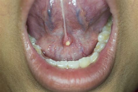 Salivary Gland Disorders And Tumours Revise Dental