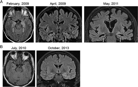 Natural Course Of Lgi1 Encephalitis 35years Of Follow Up Without