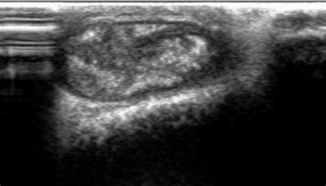 Trichilemmal Cyst Image