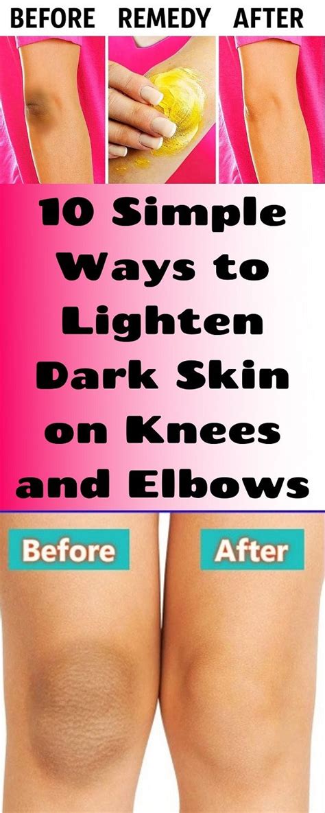10 Simple Ways To Lighten Dark Skin On Knees And Elbows Try Me Today