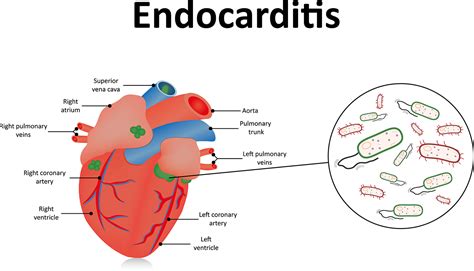 Endocarditis Drcraghu