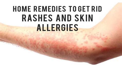 Home Remedies To Get Rid Of Rashes And Skin Allergies Youtube