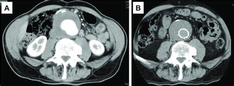 A Computed Tomography Ct Of The Abdomen Revealing A 67 Mm Abdominal