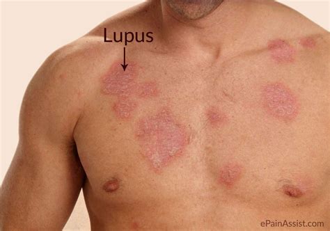 Lupus Sistemico