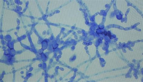 Fungal Meningitis How A Wimpy Ubiquitous Black Mold Turned To The