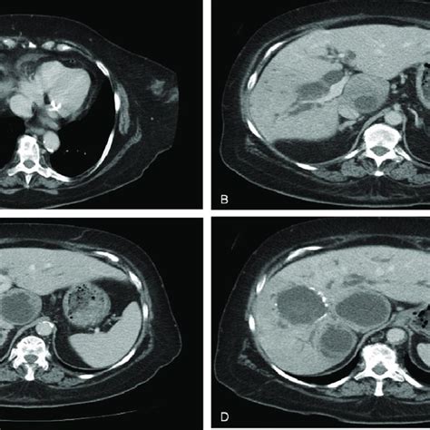 Ct Scan Revealing Multiple Hydatid Cysts Of The Right Hepatic Lobe