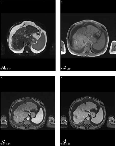 Post Microwave Ablation Therapy Oval Area In The Right Lobe Shows Low