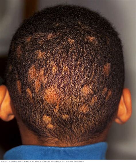 Ringworm Scalp Disease Reference Guide